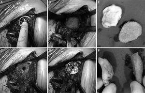 (A) Rasping the bed. (B) Final result, a suitable bed for the implantation of the metaglene. (C) Orifice for the lug. (D) Metaglene implanted with 4 locked compression screws. (E and F) Carving the bone graft based on the cement model.