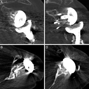 Coronal and axial CT scans at follow-up examinations of 4 of the patients, showing the integration of the bone graft used for the glenoplasty in the alografts (A and B) and in the autografts (C and D).
