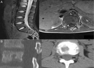 Patient 1. Lytic lesion in axial and sagittal slices of MRI and CT scans of the lumbar spine. (A) MRI, note the oedema in L1. (B) CAT, note the lesion occupying 30% of L1.