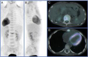 Patient 1. PET-CT images showing increased metabolic activity L1 and xiphoid process. (A) and (B) Three-dimensional reconstruction. (C) Hypermetabolism in L1. (D) Hypermetabolism in xiphoid process.