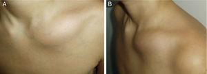 Patient 3. Photographs of the clinical appearance of a chronic osteomyelitis focus in the left clavicle, (a) view from the front, (b) lateral view of the tumour, it should be highlighted that the patient was referred to our centre due suspected malignant neoplastic disease.