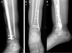 Bilateral fracture: (A) antero-posterior and lateral radiography of synthesis by intermedullary nail. (B) Antero-posterior and lateral radiography using a medial plate with locking screws, very good outcomes according to Schmeiser et al. criteria.