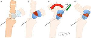 Arthroscopically-assisted scaphoid reconstruction technique. After drilling the borders, the scapholunate is attached to the radiolunate to reduce the proximal pole (A). The graft is placed in the space created (B) and the wrist is reduced in maximum extension (C) to place the distal pole in its most anatomic situation (1) and provide length. It is fixed in placed with a 1.2-mm Kirschner wire (2) and both segments are fixed with the graft using headless cannulated screw (D).