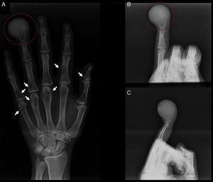 (A) The lytic image of the distal phalange of the right ring finger is shown in the red circle on an AP view. The white arrows indicate the other lesions in the phalanges and metacarpals. (B and C) Narrow oblique and lateral X-rays respectively of the right ring finger. The lytic image of the distal phalange of the right ring finger is shown in the red circle.