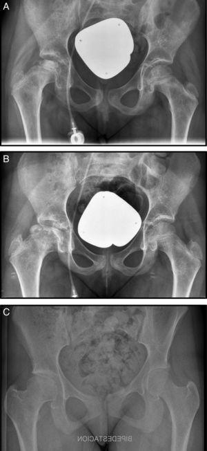 (A) Anteroposterior radiograph (AP Rx) of the pelvis showing condensation of the right femoral epiphysis pelvis. (B) AP Rx of the pelvis, one year later, showing subchondral collapse in the right femoral head. (C) AP Rx of the pelvis, at 6 years after conservative treatment showing complete remodelling of the head.