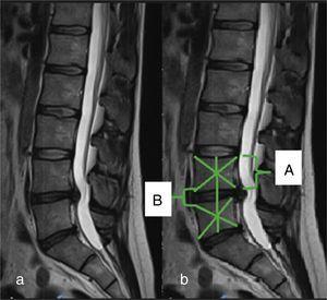 Male patient aged 34 with a central lumbar disc hernia at L4-L5. Measurement of the percentage of the disc height at hernia level with respect to the superjacent vertebra: (a) sagittal slice from magnetic resonance imaging; (b) measurement of sagittal disc height and upper vertebral body. Disc height index (B/A×100).