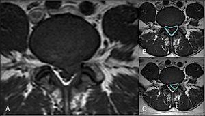 Male patient aged 25, who presented with an L4-L5 posterolateral hernia. Measurement of the spinal canal percentage occupied by the disc extrusion: (A) axial magnetic resonance at protrusion level; (B) measurement of the spinal canal diameter; (C) measurement of the hernia diameter.