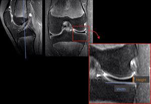 Measurement of meniscal height and width.