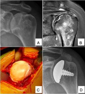 51-Year-old patient diagnosed with humeral head ABN treated with partial resurfacing arthroplasty (HemiCup®). (A and B) Radiography and magnetic resonance imaging of the left shoulder showing signs of subchondral collapse, and integrity of the glenoid surface (Cruess 3). (C) Intraoperative image showing loss of humeral head sphericity. (D) Control radiography at 52 months postoperatively, showing good outcome.