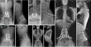 Patient A. (A, B) Resection of L5 vertebral body. Interbody mesh. Posterior fixation L4-S1. (C, D) Failure of material. (E, F) Extension of instrumentation from L2 to S2. (G, H) Failure of material. (I, J) Definitive postoperative outcome. Extension of instrumentation from L2 to iliac bones.