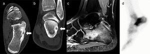 Case 3: axial (a) and coronal slice (b) of CT; Sagittal MRI T-2 weighted sequence (c); and bone scintigraphy (d). The CT shows the nidus with central calcification (arrows); MRI shows extensive calcaneal oedema, and on scintigraphy focal uptake of radionuclide interpreted as a stress fracture.