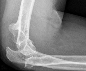 Lateral X-ray of a terrible triad of elbow.