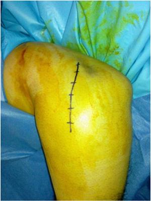 Incision for lateral elbow approach.