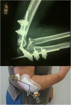 External fixator as treatment for terrible triad of elbow.