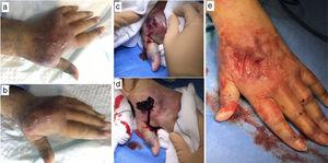 The surgical drainage process of a tension haematoma in the hand: (a and b) Tension haematoma in the hand with skin involvement. (c) Deep incision over the fluctuating zone. (d) Emptying the haematoma. (e) Skin without tension.