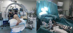 Left hip. (A) Intraoperative placement of the patient and of the radioscopy. (B) Surgical field set-up.