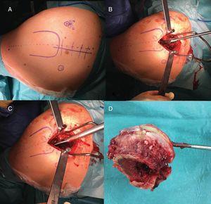 Left hip. (A) Cutaneous incision. (B) Femoral preparation without hip dislocation through femoral neck with reamers. (C) Femoral preparation without hip dislocation through femoral neck with rasps. (D) Femoral head removal after osteotomy through the rasp.