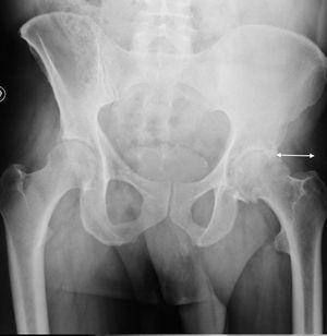 Left hip. Preoperative radiology. Measuring the distance between the lateral area of the acetabular rim and the apex of the greater trochanter.