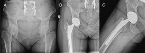 Right hip. SuperPath approach. (A) Preoperative radiology. (B and C) Control Radiological follow-up 3 months after surgery.