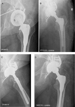 Reconstruction For Pelvic Discontinuity And Massive Acetabular Defects ...