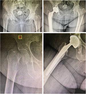 86-year-old female patient. A) Anteroposterior X-ray of both hips. B) Lateral X-ray of the right hip. C) X-ray of both hips at last follow up. D) Lateral X-ray of right hip at last follow up.