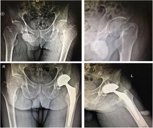 90-year-old female patient. A) Anteroposterior X-ray of both hips. B) Lateral X-ray of the left hip. C) X-ray of both hips at last follow up. D) Lateral X-ray of left hip at last follow up.