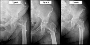 Examples of lateral wall fracture sub-classification.