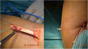 Morrey’s modification of the Boyd Anderson approach. (A) Preparation of the tendon. Suture of each of the bundles, Krackow type, with two different threads, to identify each tendon portion. (B) Transfixing forceps exiting through the posterior region of the forearm to serve as transport for suture threads.