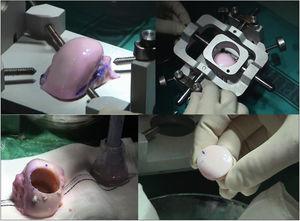 Preparation of the graft: the pinkish colour of the graft due to the culture medium can be seen. Working table: showing harvesting the graft, washing with a pulse lavage gun to wash away bone cells and debris and, finally, the osteochondral graft.