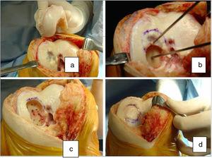Osteochondral lesion and its allograft (a). Surgical procedure, using 2 embedded allografts (b and c). Final result (d).