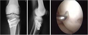 Same patient as Fig. 3, at one year, valgus osteotomy and arthroscopic revision.