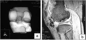 Control imaging at 3 months: helical CT (a) and MRI (b).