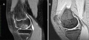 A) Osteochondritis dissecans (Dipaola grade II), preoperative MRI image. B) Bone union on postoperative MRI at 5 years.