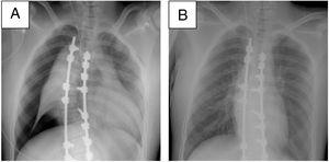 Pneumothorax. (A) Right pneumothorax. (B) X-ray after removal of chest drain, pneumothorax resolved.