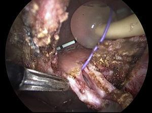 Se observa la vejiga ya abierta, se circuncida la fístula, previamente referida con guía colocada por cistoscopia; nótese la sonda transuretral y los catéteres ureterales.