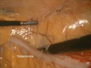 Disección laparoscópica de la fascia de Toldt.