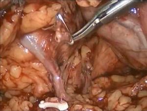 Ligadura y sección de la vena y arteria renal.