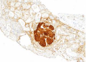 Renal biopsy (son). Immunohistochemistry for Apo AI, with intense positivity in glomerular deposits (×200).