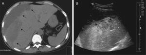 Abdominal computed tomography (A) and liver ultrasound (B) revealing a large subcapsular liver hematoma (13.8cm×3.9cm) (arrows) causing compression of the underlying liver parenchyma. No source for the hemorrhage was evident.