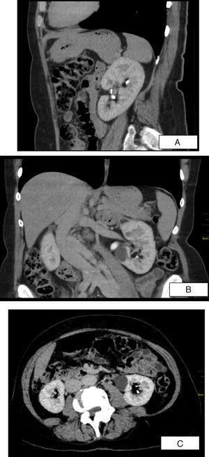 A, B, C: Sagital, coronal and axial sections of abdominal computed tomography revealing structural heterogeneity of the left renal parenquima with diminished enhancement at the tip of the medullary pyramid and the presence of small cavities filled by contrast on the borders of the small calices – aspects highly suggestive of papillary necrosis ischemia.
