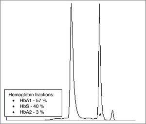 Hemoglobin electrophoresis (cellulose acetate): amino acids substitution in hemoglobin variants alter charge and subsequently hemoglobin's mobility pattern. Presence of an abnormal hemoglobin variant in Z5 region, compatible with HbS (*).