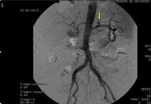 Angiography after percutaneous transcatheter embolization of the pseudoaneurysm.