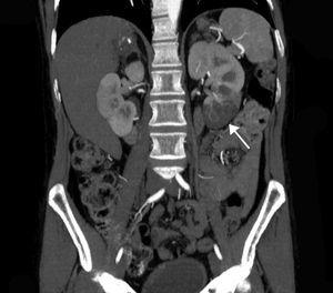 Contrast-enhanced CT scan showing perfusion defect in the lower pole of the left kidney (arrow) corresponding to the area of the renal infarction. The degree of damage in this case would be 1/6 (17% of the total renal parenchyma).
