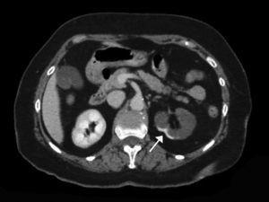 Transverse contrast-enhanced CT scan showing findings suggestive of renal infarction with involvement of most of the left kidney. Cortical rim sign can be appreciated (arrow). The degree of damage in this case would be 3/6 (50% of the total renal parenchyma).