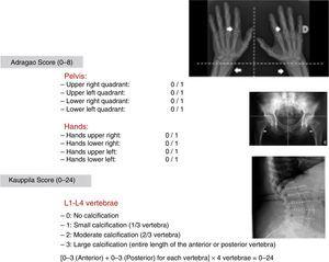 Adragao Score: Plain x-ray of the hands and pelvis. Determined by the sum of the absence of calcification (0 points), unilateral (1 point) or bilateral (2 points) presence of linear calcifications in each section. It analyses calcification of the iliac, femoral, radial, and digital arteries. The final value ranges between 0 and 8 points (0–4 in the pelvis and 0–4 in the hands).58 Kauppila Score: A lateral abdominal x-ray is performed that includes from the T-10 vertebra to the first 2 sacral vertebra. The aorta is identified as a tubular structure in front of the vertebral column. Only the segments of the abdominal aorta that are in front of the first 4 lumbar vertebrae (L1-L4) are analysed. The score is assigned from 1 to 3 [1: small calcification (1/3 the vertebra length), 2: moderate (2/3), 3: large (affects more than 2/3 of the vertebrae length)] according to the length of each detected plaque. Both the anterior and posterior part of the aorta are taken into account, relating them with the location according to where they are located in front of the L1, L2, L3, or L4 vertebrae. With this scoring, a final score is reached between 0 and 24 points.135
