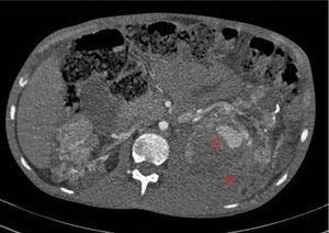 Increase in the size of the left retroperitoneal haematoma (B) and in the aneurysm visible in the upper third of the kidney as compared to the previous study (C).