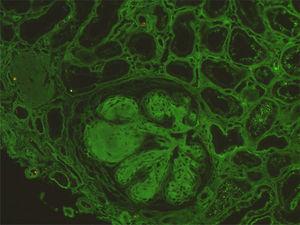 Immunofluorescence for κ-light chain reveals diffuse linear staining of the glomerular basement membranes.