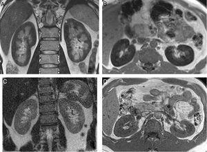 (A) Coronal T2 sequence image. Diffuse low signal of the renal cortex suggesting the presence of iron deposit. (B) Axial T1 in-phase sequence also shows low signal of the renal cortex compared to the liver and skeletal muscle. (C) MR of the same patient 17 months after start of treatment. Coronal T2 sequence image shows disappearance of the low signal on T2. (D) Axial T1 in-phase sequence also demonstrates normal intensity of the renal cortex.