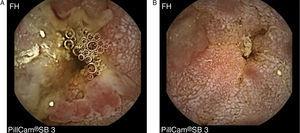 Endoscopic evaluation using videocapsule showing diffuse thickening of intestinal folds, intense lymphangiectasia and a nodular mucosa with multiple ulcers.