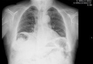 Thoracic X-ray with Chilaiditi syndrome.